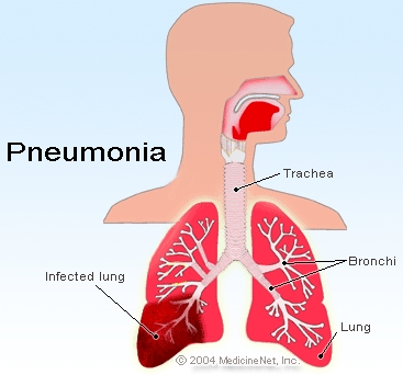 Apie pneumokokinę vakciną, jei vaikas sirgo plaučių uždegimu