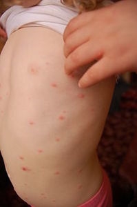 Contact with a child with chickenpox