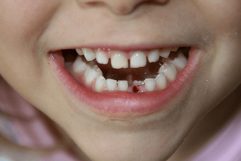 Barnet har en hævet tyggegummi mellem mælken og de molære tænder