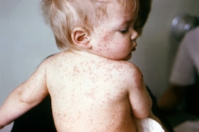 Un niño de 8 meses tiene conjuntivitis, secreción nasal y tos.