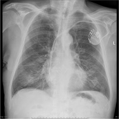 Suurentunut sydän röntgenkuvassa
