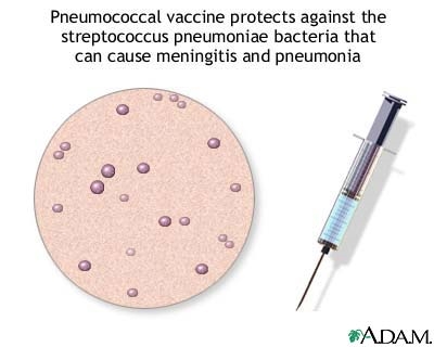Despre vaccinul pneumococic dacă copilul a avut pneumonie