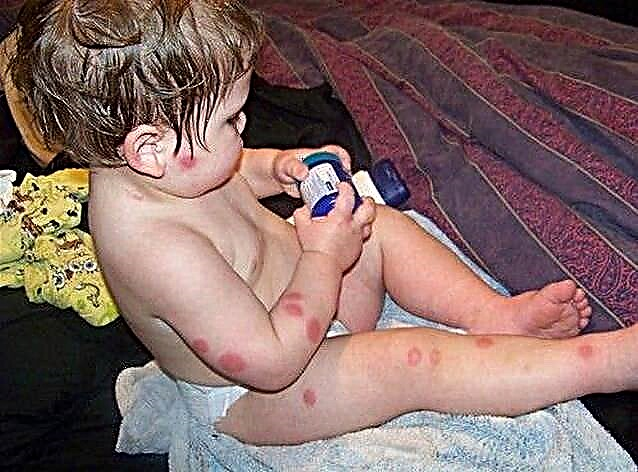 Bir çocukta alerji - ne yapmalı
