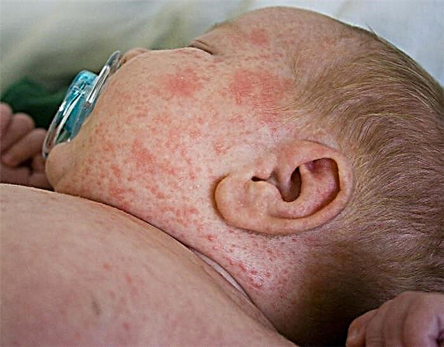 A child has a rash on the body - what is it