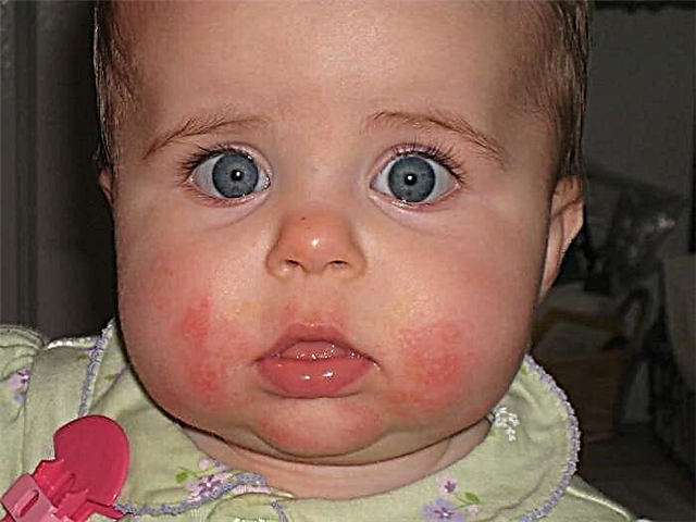 Alergia em bebês no rosto