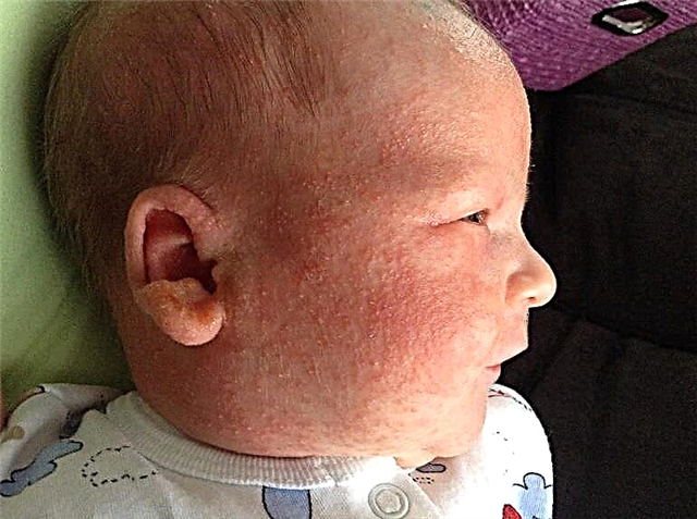 赤ちゃんの発疹は何ですか