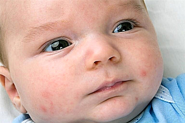 Hautausschlag und Fieber bei einem Kind