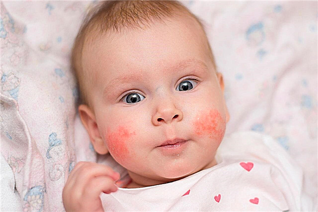 Allergie voor boekweit bij baby's tot een jaar