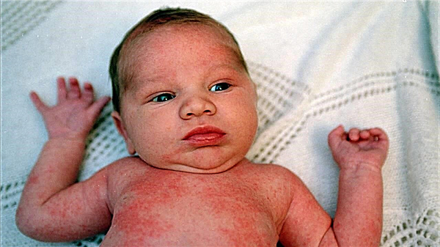 Hoe stekelige warmte te onderscheiden van allergieën bij baby's