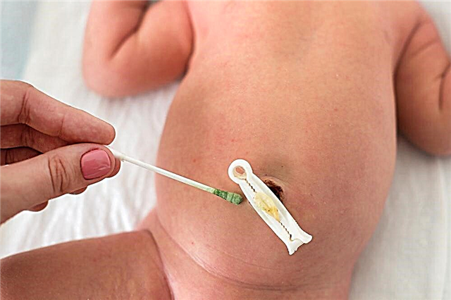 Was tun, wenn der Nabel eines Neugeborenen nach der Heilung etwas blutet?