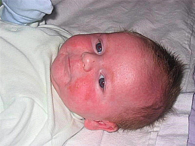 Những đốm đỏ trên mặt của một em bé sơ sinh