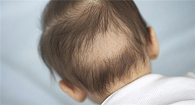 כתמים קרחים על גב ראשו של התינוק - שממנו הילד מתקרח