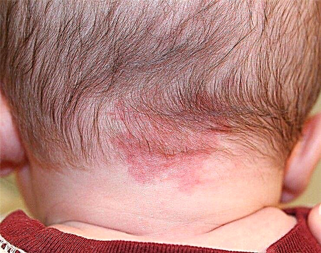 赤ちゃんの頭の後ろにある赤い斑点-それは何ですか