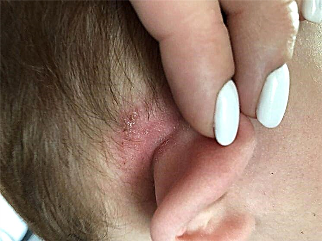Trockene Krusten hinter den Ohren eines Kindes und Peeling - was tun?