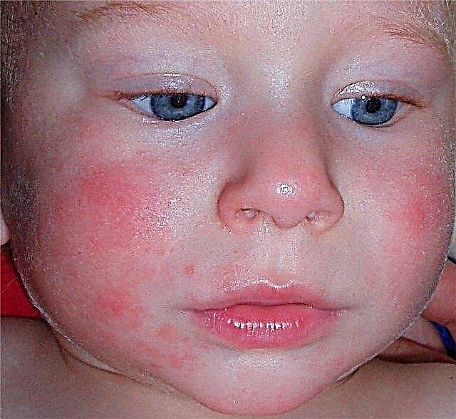 Κόκκινα μάγουλα στα μωρά - γιατί γίνονται κόκκινα και νιφάδες