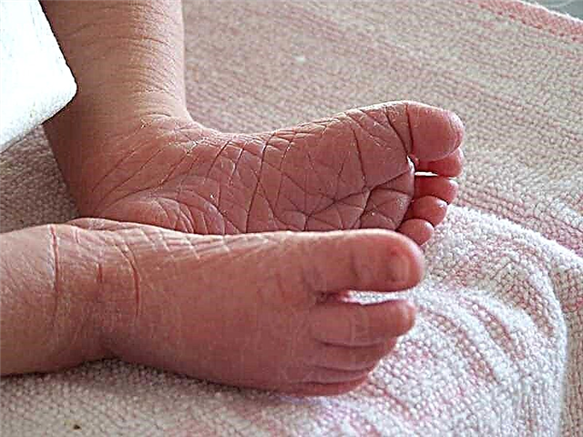 Hvorfor har et barn skrællende fødder - hvad man skal gøre