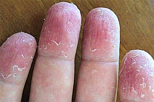 מטפסת את העור על אצבעותיו של ילד - סיבות