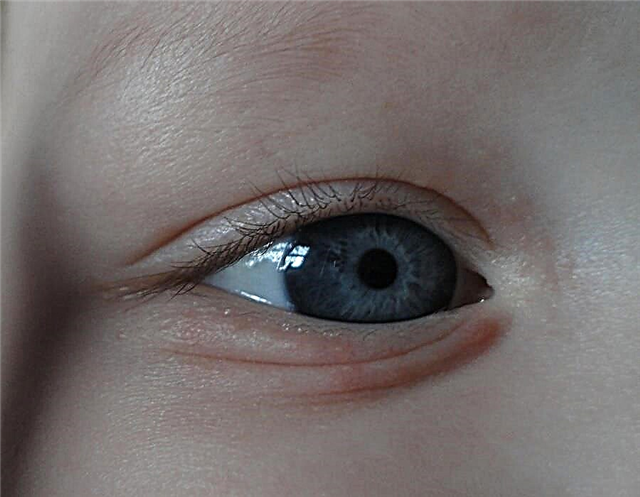 Seorang kanak-kanak mempunyai jerawat putih di kelopak mata - apa itu, adakah saya perlu pergi ke doktor