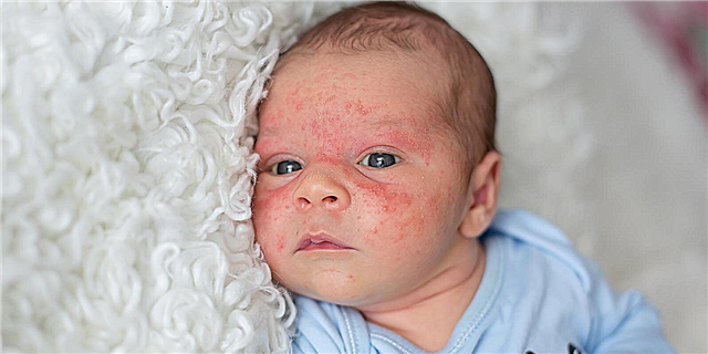 Røde prikker omkring et barns øjne - mulige årsager til udslæt