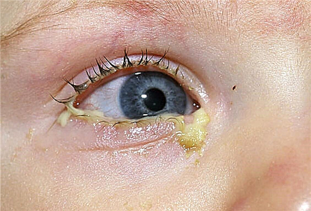 Hvorfor spiser øynene til et barn, hva du skal gjøre, hvordan du fjerner pus