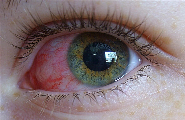 A vessel burst in a child's eye - possible reasons for what to do