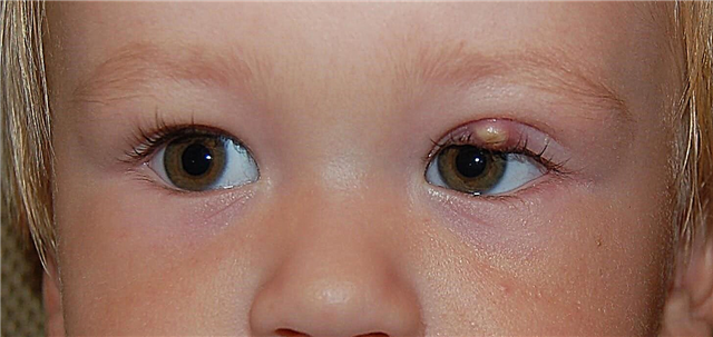 The child has a swollen eye - possible causes, alarming symptoms