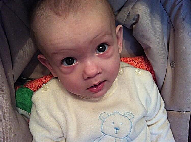 Bolsas debajo de los ojos en un niño: causas de aparición en los bebés