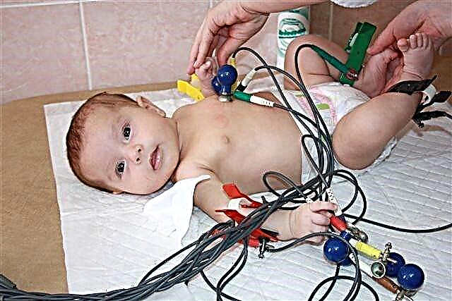 ECG bij een kind jonger dan een jaar - decodering van een cardiogram