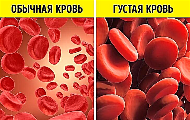 Paks veri vastsündinul - põhjused ja tagajärjed