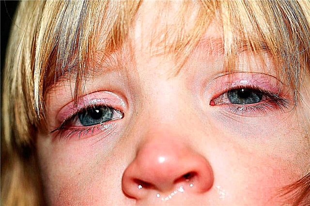 Oči djeteta nateču nakon spavanja - mogući uzroci, simptomi