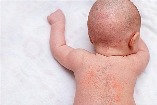 Uma erupção nas costas de uma criança - de onde vem a acne vermelha