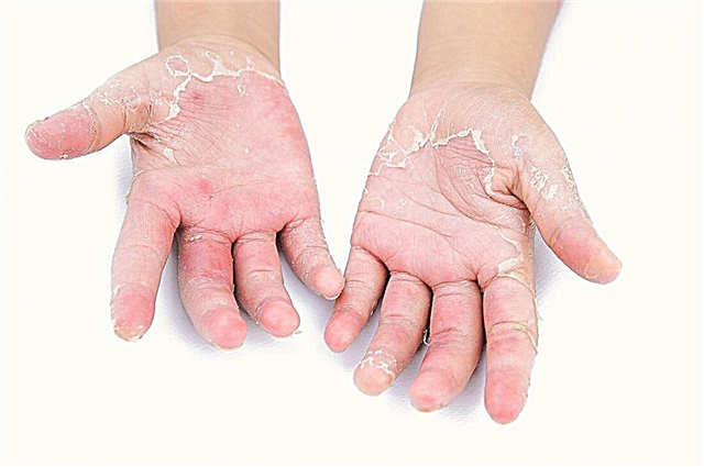 Por que uma criança tem as palmas das mãos descamadas - eliminação da aspereza