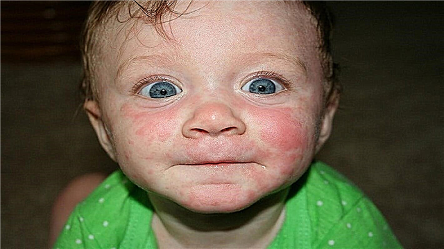 乳児のロゼオラ-発疹の症状