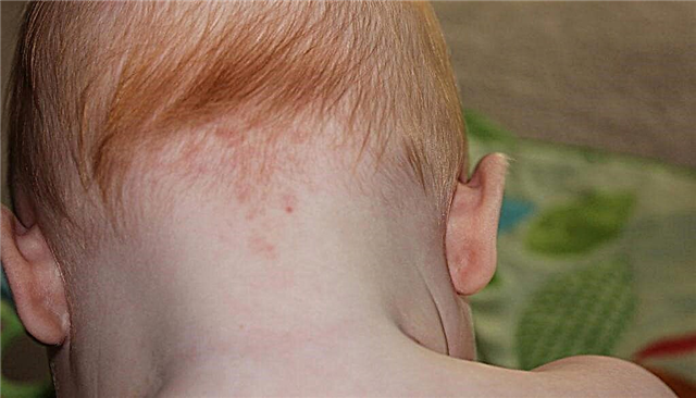 Ένα εξάνθημα στο λαιμό του παιδιού, στο στήθος - πιθανές αιτίες