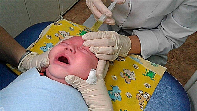 Soi tuyến lệ ở trẻ sơ sinh