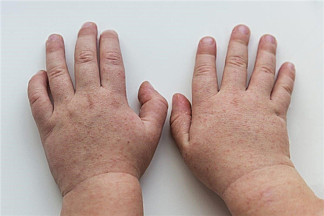 Osip na dlanovima djeteta u obliku mjehurića, prištića, žuljeva
