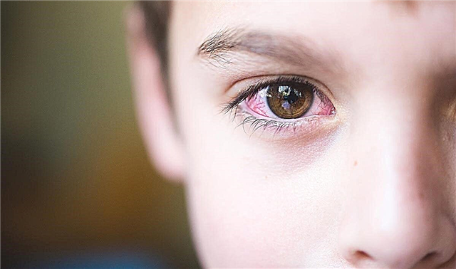 Røde øyne hos et barn - typer rødhet, årsaker, symptomer