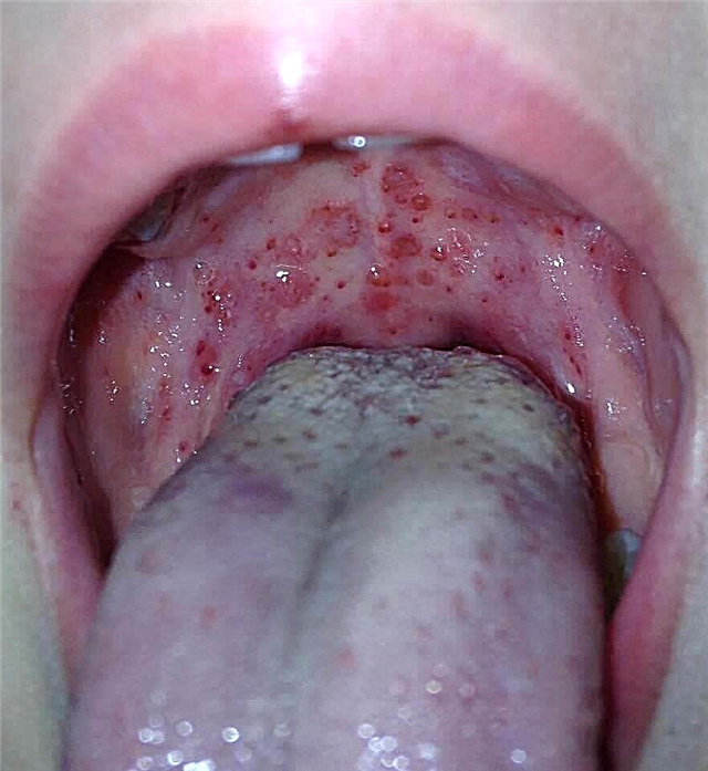 Petite éruption cutanée rouge sur la langue d'un enfant - les raisons de l'apparition