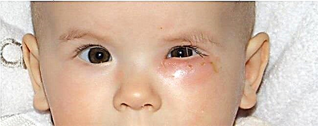 Prekážka slzného kanála u novorodencov - príznaky upchatia