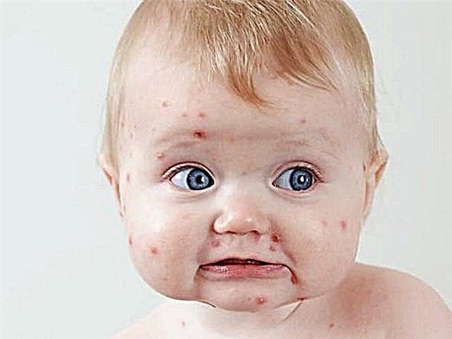 A rash on the face of a child - what is it, types of rashes