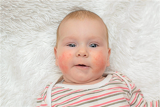 Alergia em uma criança no rosto - como é a erupção na pele