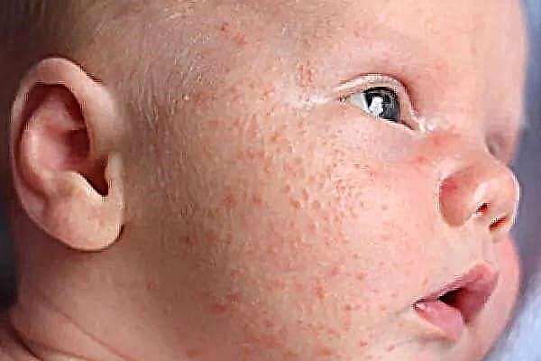Обриви по лицето и главата на новородено - какво е това