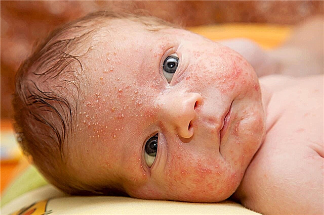 Hormonálna vyrážka na tvári u novorodencov