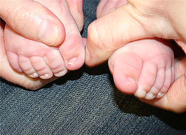 เล็บขบในเล็บเท้าของทารก - จะทำอย่างไรถ้ามันเปลี่ยนเป็นสีแดง
