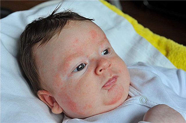 Hoelang duurt de allergie van een baby nadat het allergeen is geannuleerd