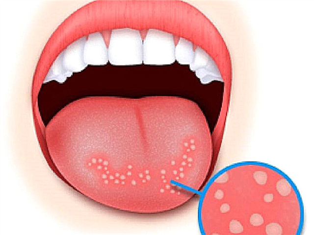 Pontos vermelhos no palato de uma criança, febre, vermelhidão na garganta