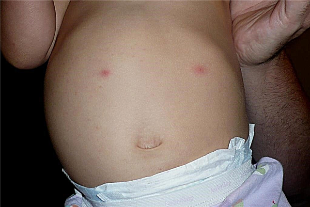 A rash on the abdomen of a child - possible causes