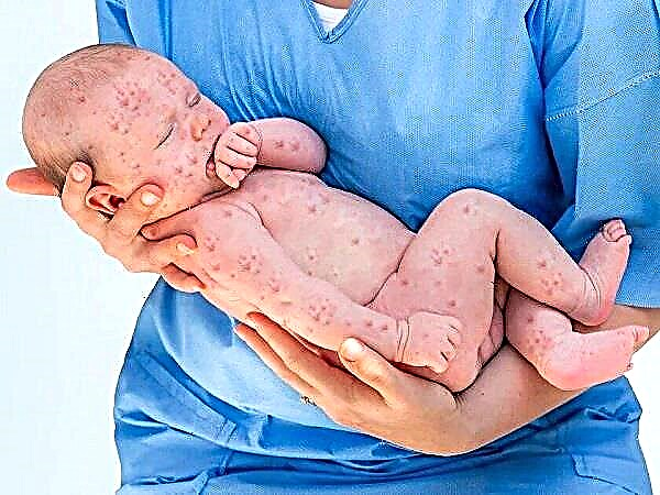 طفح جلدي مع ظهور بثور عند الطفل ، بثور على الجلد - ما هو