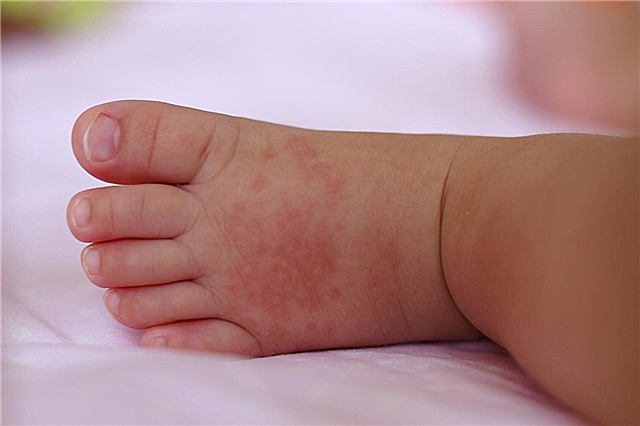 Mi okozza a kiütést az egy év alatti gyermek lábain - lehetséges okok