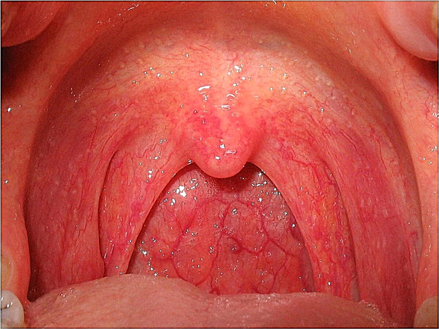 Una erupción en la garganta de un niño: posibles causas